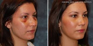 Being able to recognize a broken nose can help ensure that a person or child receives appropriate treatment. Broken Nose Treatment Los Angeles Ca