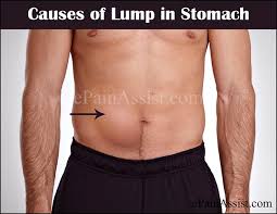 As stomach cancer becomes more advanced, the symptoms become more prominent and noticeable. Lump In Stomach Or Abdominal Mass Causes Symptoms Treatment Prognosis Diagnosis