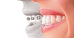 Check spelling or type a new query. Braces Vs Invisalign