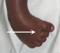 What is the meaning of club foot? Assessing Children With Clubfoot Physiopedia
