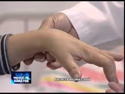 Artrita reumatoida apare atunci cand sistemul imunitar ataca membrana sinoviala (membrana care captuseste cavitatea articulara) si determina cresterea in exces a acesteia, cu erodarea capetelor osoase, limitarea mobilitatii, durere, ducand in timp la deformarea. Artrita Reumatoida Youtube