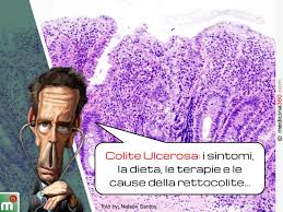 Secondo alcuni studi, la rettocolite ulcerosa può aumentare il rischio di tumore del colon a causa dell'infiammazione intestinale nelle forme più comuni della malattia, dovute ad alimentazione, è bene ricordare che zucchero, cibi troppo grassi e carboidrati raffinati sono nemici. Colite Ulcerosa Sintomi Dieta Terapia E Cause Della Rettocolite