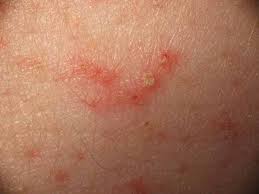 Epidemiologia Y Control De La Sarna O Escabiosis Salud Publica Y Algo Mas