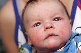 In severe cases, you may have to apply a thick coat of this oil and wrap it with a wet bandage, so that it has the chance to permeate the skin. What Can I Do About Baby Eczema