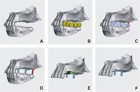 Many american seniors have come to the rather unwelcome realization that dental implants are not really affordable for seniors. A Digital Workflow For Modeling Of Custom Dental Implants 3d Printing In Medicine Full Text