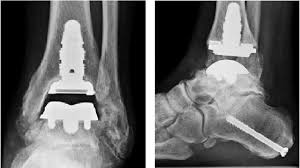 Current And Emerging Insights On Total Ankle Replacement Podiatry Today Ankle Replacement Ankle Arthritis Bone Loss
