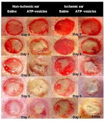 Maybe you would like to learn more about one of these? Intracellular Delivery Of Adenosine Triphosphate Enhanced Healing Process In Full Thickness Skin Wounds In Diabetic Rabbits Abstract Europe Pmc