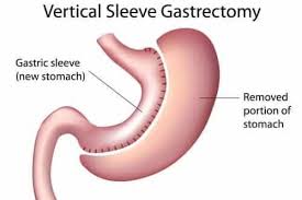 However, procedures that remove part of the stomach (only gastric sleeve, gastric bypass, and duodenal switch) are more likely to improve or cure type 2 diabetes than procedures that leave. Advantages And Benefits Of Gastric Sleeve Surgery Jet Medical Tourism