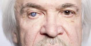 Blindness| Visual Impairment Myths Facts