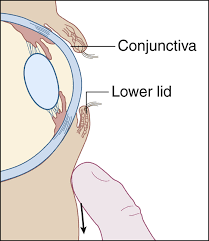Image result for Conjunctival Foreign Body