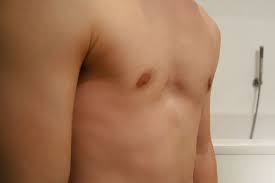 Poland syndrome is historically associated with hypoplasia of the pectoral major muscle and abnormalities of the upper limbs. Trichterbrust