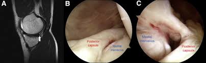 The medial condyle is one of the two projections on the lower extremity of femur, the other being the lateral condyle. An Increased Lateral Femoral Condyle Ratio Is An Important Risk Factor For A Medial Meniscus Ramp Lesion Including Red Red Zone Tear Arthroscopy