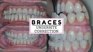 It makes the chin and lower teeth more prominent, which is not found normally. Fixing An Underbite With Adult Braces No Surgery Correcting Underbite With Orthodontia Youtube