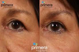 Check spelling or type a new query. Brow Lift Before And After Photo Gallery Orlando Florida Primera Plastic Surgery