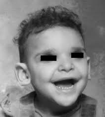 (a) 1 año y 6 meses; Outcomes Of Hirschsprung S Disease Associated With Mowat Wilson Syndrome Journal Of Pediatric Surgery