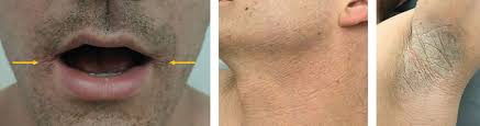Image result for Diffuse Hyperpigmentation