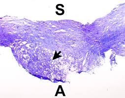 Immunohistochemistry and electron microscopic findings showed that the tumor was a subtype of epithelioid mesothelioma. Pathology Outlines Diffuse Malignant Mesothelioma