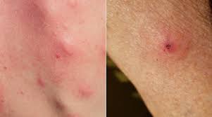 We did not find results for: Is That A Mosquito Or Tick Bite How To Tell These Bug Bites Apart