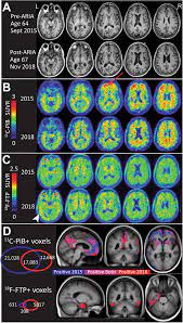 Fda approves biogen's (biib) aduhelm (aducanumab), making it the first medicine to be approved to reduce the clinical decline associated with alzheimer's disease. Symptomatic Amyloid Related Imaging Abnormalities In An Apoe E4 E4 Patient Treated With Aducanumab Vandevrede 2020 Alzheimer S Amp Dementia Diagnosis Assessment Amp Disease Monitoring Wiley Online Library