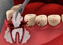 Bone Graft Procedure Step By Step Cost In The Uk And Abroad Nhs