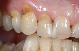 Image result for Tooth Abrasion