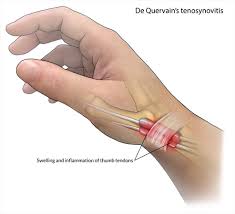 Sakit Pergelangan Tangan Ibu Jari 5 Perkara Tentang Dequervain S Tenosynovitis Mama Perlu Tahu