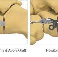 Evans Osteotomy Plate - Lower Extremity Fixation - TriMed Inc.