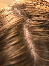 Largely harmless, a cherry angioma is a cluster of burst skin vessels that can appear anywhere on the body. Anyone Know What His Red Thing Is On My Scalp I Have A Ton Of Them On My Scalp Womenshealth