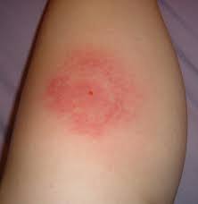 Mosquito Bite Allergy Skeeter Syndrome Skeeter Syndrome Symptoms