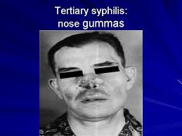 Syphilis definition syphilis is an infectious systemic disease that may be either congenital or acquired through sexual contact or contaminated needles. Syphilis Background Treponema Pallidum Is The Microaerophilic Spirochete