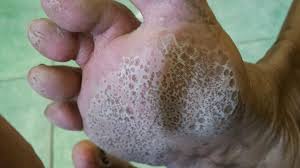 Image result for Pitting nails feet