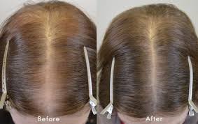 In this study, a 0.005% finasteride solution applied twice a day was found to decrease the rate of hair loss compared to placebo with just six months of application. Finasteride Results Archives Hair Restoration Of The South