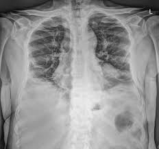 Image result for Chest Trauma