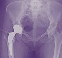 Prótese de quadril via anterior: como funciona a cirurgia