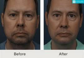 How much does buccal fat removal cost? Buccal Fat Excision For Natural Facial Features In Charlotte