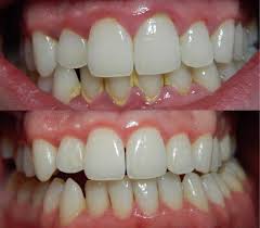 Take care of your oral health between dental visits. Gingivitis Causes Symptoms And Treatment