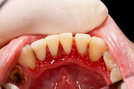 Image result for Gingivitis
