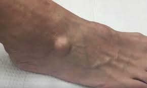 Got a bit carried away with a hard skin remover file after a hot bath and it bled. Video Shows A Doctor Cutting A Lump The Size Of A Grape Out Of A Man S Foot Daily Mail Online