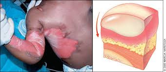 If a burn scab (eschar) goes completely around a limb, it can tighten and cut off the blood circulation. Ambulatory Management Of Burns American Family Physician