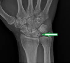 Ulnar Impaksiyon Istanbul Elcerrahisi