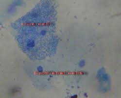 Ureaplasma has been associated with resistant bv infectio. How Can The Presence Of Clue Cells Be Explained In Vaginosis