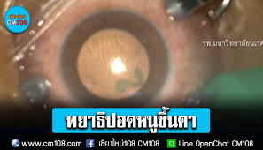แพทย์แถลงพบผู้ป่วยโรคพยาธิปอดหนูขึ้นตา เป็นรายแรกของจังหวัดพิษณุโลก โดยผู้ป่วยถึงขั้นตาบอด สาเหตุมาจากการกินอาหารสุกๆ ดิบๆ เป็นประจำกดติดตาม . Qliydf7wavqepm