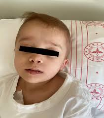 Myeloid Sarcoma presentetion as brain tumor in pediatric acute myeloid  lekeumia