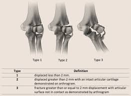 Image result for Lateral Condyle Fracture