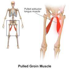 The groin is the area that lies between the abdomen stomach and thighs. Groin Wikipedia