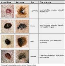 Skin cancer most often develops on areas of your body that get the greatest exposure to the sun's ultraviolet (uv) rays. Pin On My Face Features