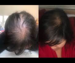 Biotin, or vitamin b7, is an essential nutrient that aids the body's metabolism. Biotin Shampoo Hair Loss Expert Opinion
