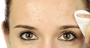 Join enfamil® family beginnings today Severe Acne During Pregnancy Modernmom