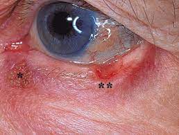 Basal and squamous cell skin cancer are types of skin cancer that are found on the outer layer of the skin. Basal Cell Carcinoma Affecting The Eyelid Images Dermnet Nz