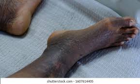 Image result for Lipodermatosclerosis